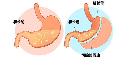 對(duì)肥胖大聲說NO!——我院開展腹腔鏡（微創(chuàng)）下胃部分切除術(shù)