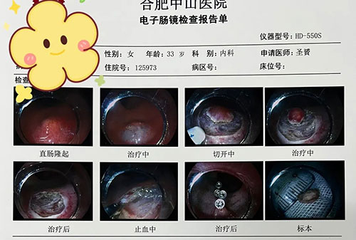 治療消化道早期腫瘤的“利器”——內(nèi)鏡下粘膜剝離術(shù)（ESD）