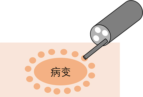 治療消化道早期腫瘤的“利器”——內(nèi)鏡下粘膜剝離術(shù)（ESD）