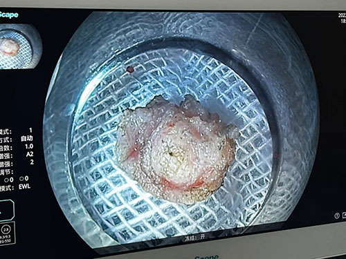 治療消化道早期腫瘤的“利器”——內(nèi)鏡下粘膜剝離術(shù)（ESD）