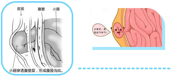 勿以“疝”小而不為：正確認(rèn)識腹股溝疝