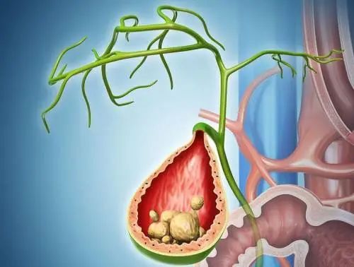 年紀(jì)輕輕不想切除膽囊？來看看這個(gè)方法！