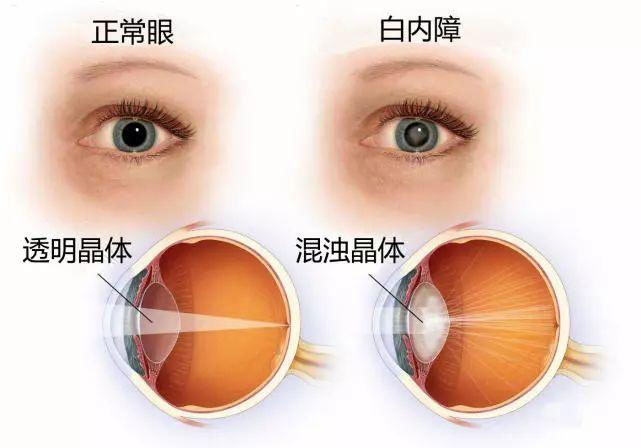 關(guān)于白內(nèi)障，這些知識幫父母了解!