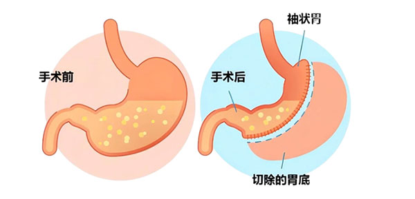 減肥不能“管住嘴”？不妨看看這個“管住胃”的方法