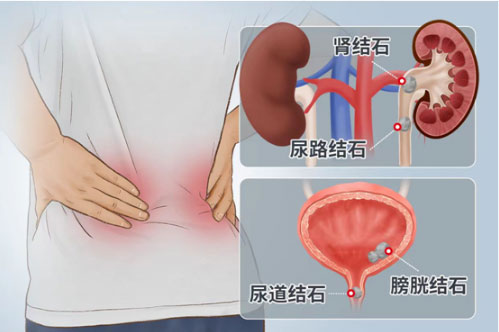 尿路結(jié)石痛不欲生？專(zhuān)家教你一招搞定！