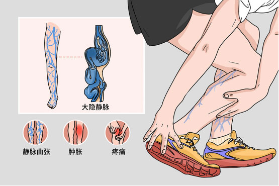 “蚯蚓腿”怎么辦？醫(yī)生：試試這幾種辦法