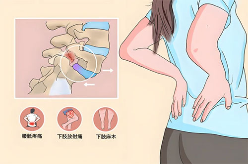 打工人的腰椎疾?。貉甸g盤突出知多少？