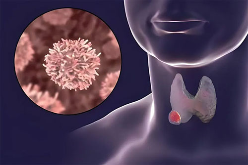 甲狀腺疾?。簞e讓這個(gè)“小東西”成為你的健康“隱形殺手”！