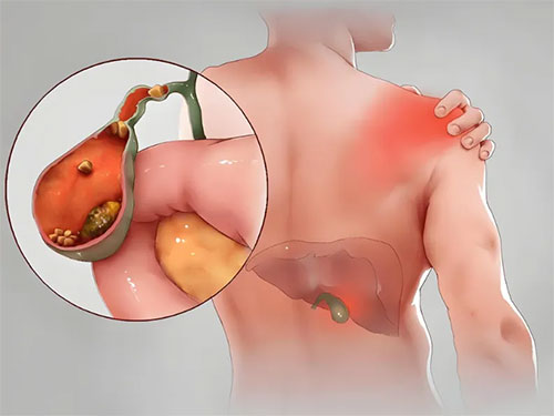 【惠民科普】膽囊里的‘不速之客’——膽囊結(jié)石