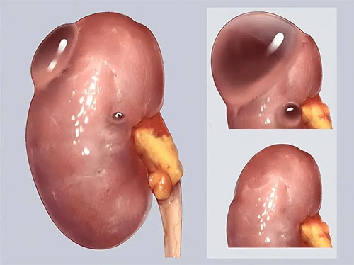 無法忽視的“水泡”——正確認(rèn)識腎囊腫