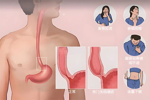 【惠民科普】73歲大爺吃啥吐啥，骨瘦如柴原因竟是食管賁門失弛緩癥??！